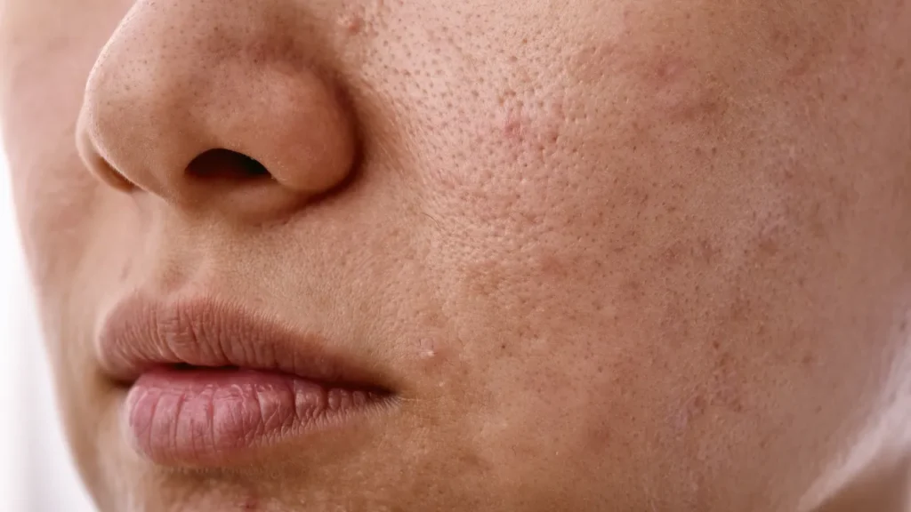 O que é bom para curar espinhas O que é bom para curar espinhas