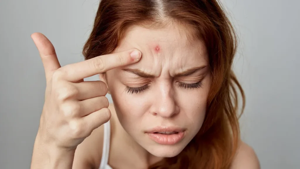O que é bom para combater espinhas no rosto O que é bom para combater espinhas no rosto